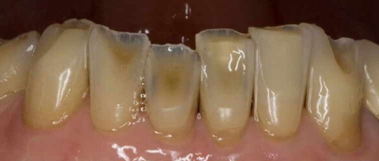 dental decay