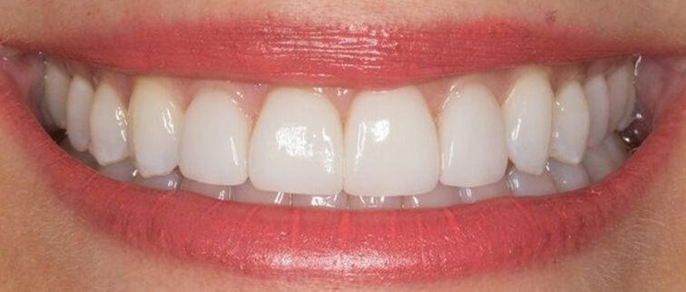 after porcelain veneers