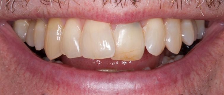before veneers