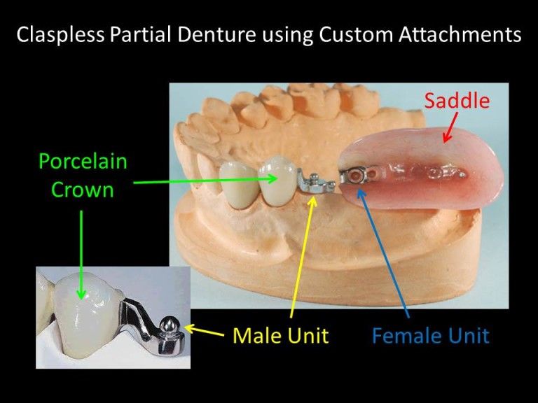 claspless denture