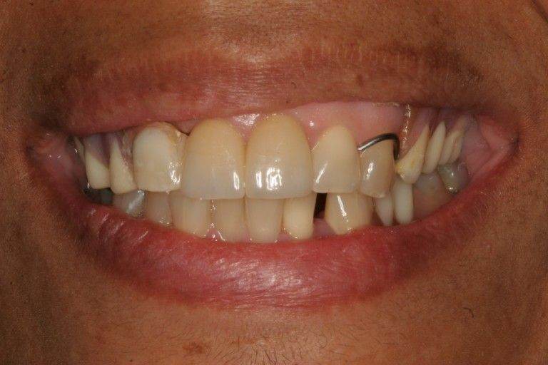 man with partial denture in