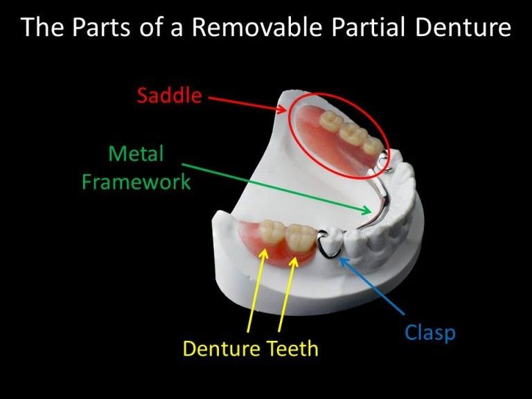 partial denture diagram