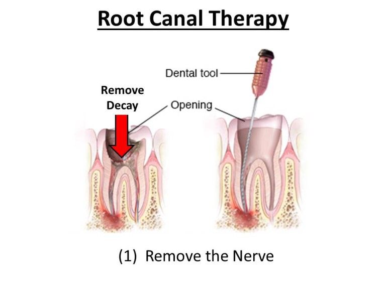 removal of nerve