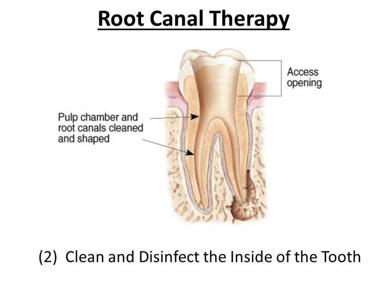 how to perform root canal therapy
