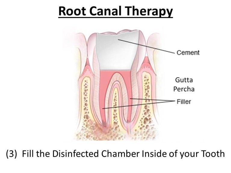 disinfect chamber of root canal infection