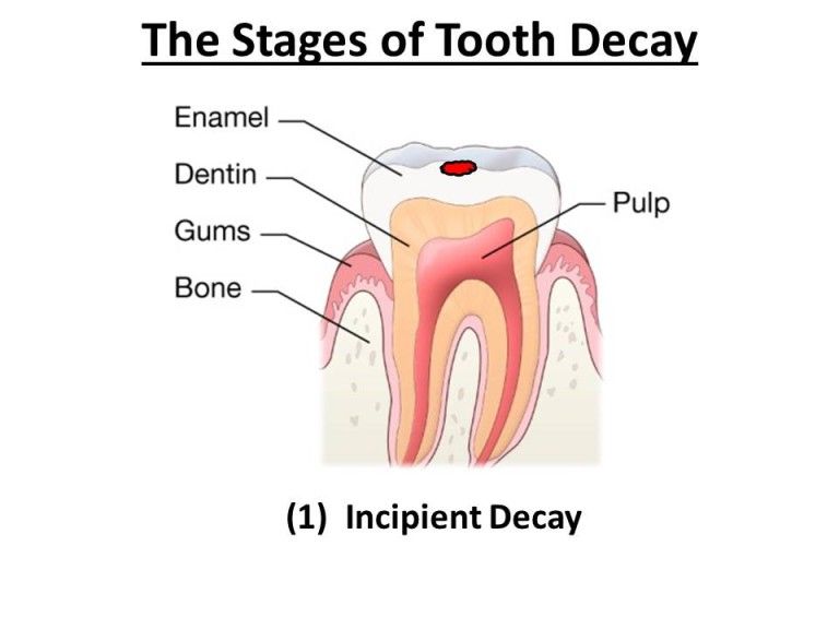 stages of tooth decay