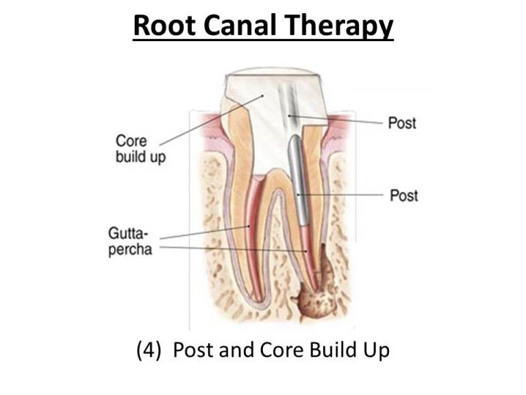 treating root canal infection