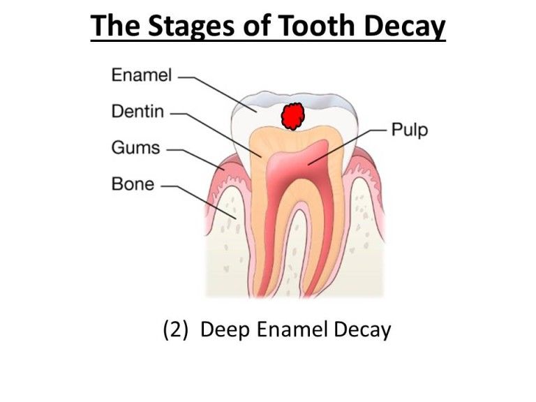 stages of decay