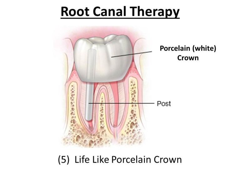 porcelain crown after root canal