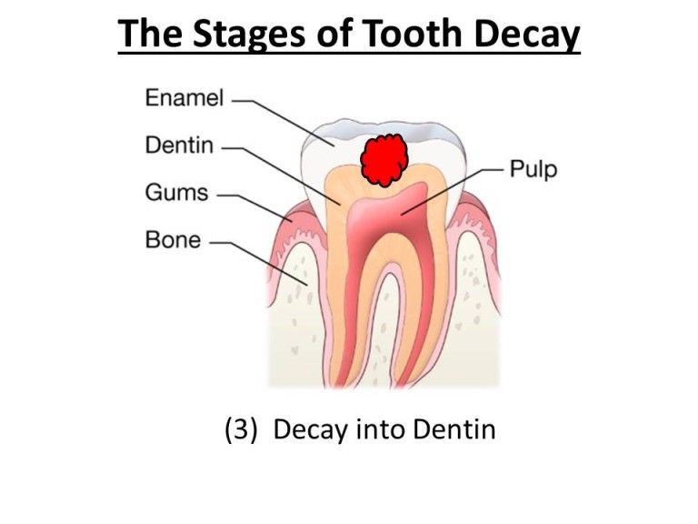 decay in dentin