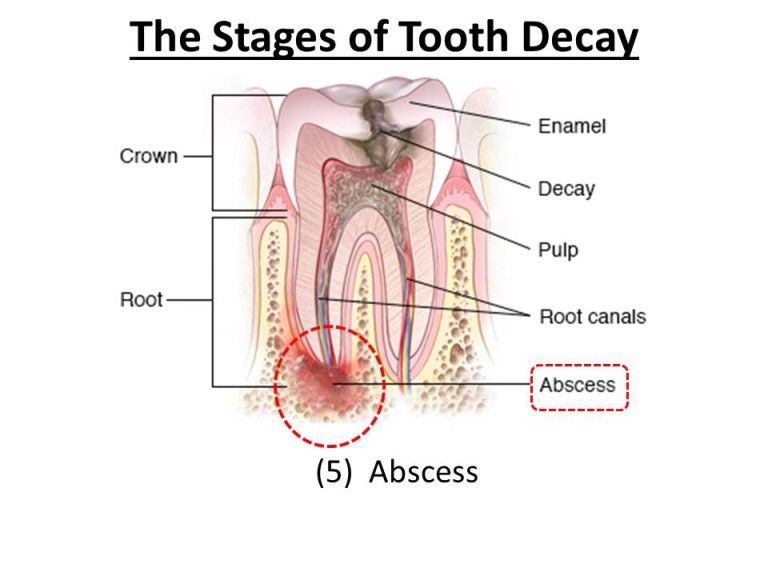 abscessed tooth