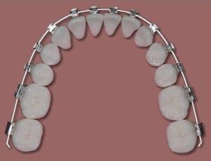 traditional braces