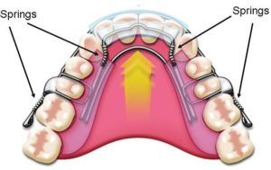 Orthodontic Appliance