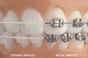 Braces Bracket