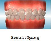 Excessive Spacing - Orthodontics in Marina Del Rey, CA