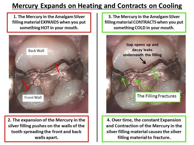 Amalgam Silver Filling