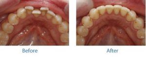 Before and After Orthodontics