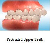 Protruded Upper Teeth