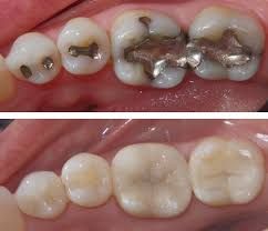 Silver Mercury Fillings Marina Del Rey