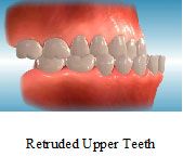 Retruded Upper Teeth