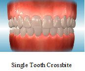 Single Tooth Crossbite