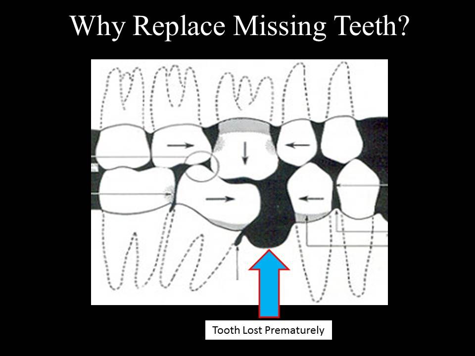 Replace Missing Teeth, Marina Del Rey