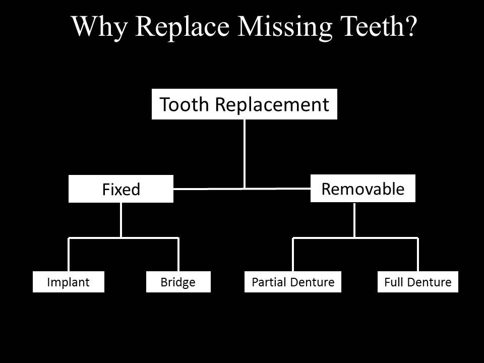 diagram for replacing missing teeth