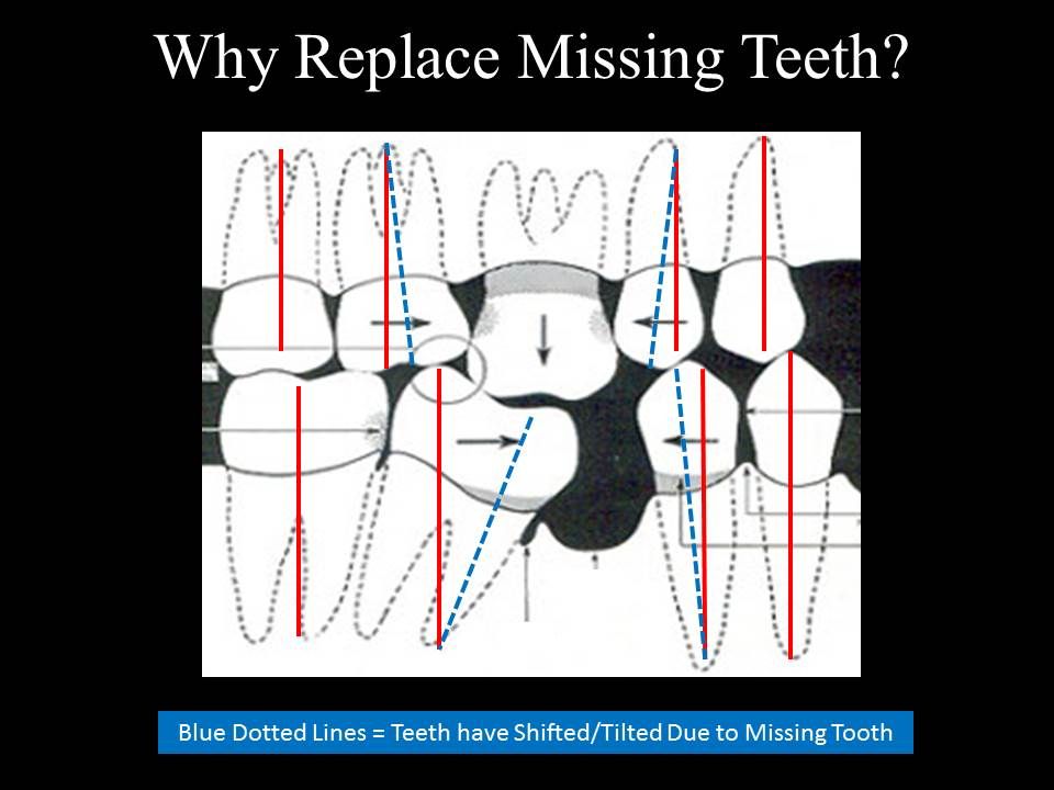 Shifting/tilting of teeth - Marina Del Rey
