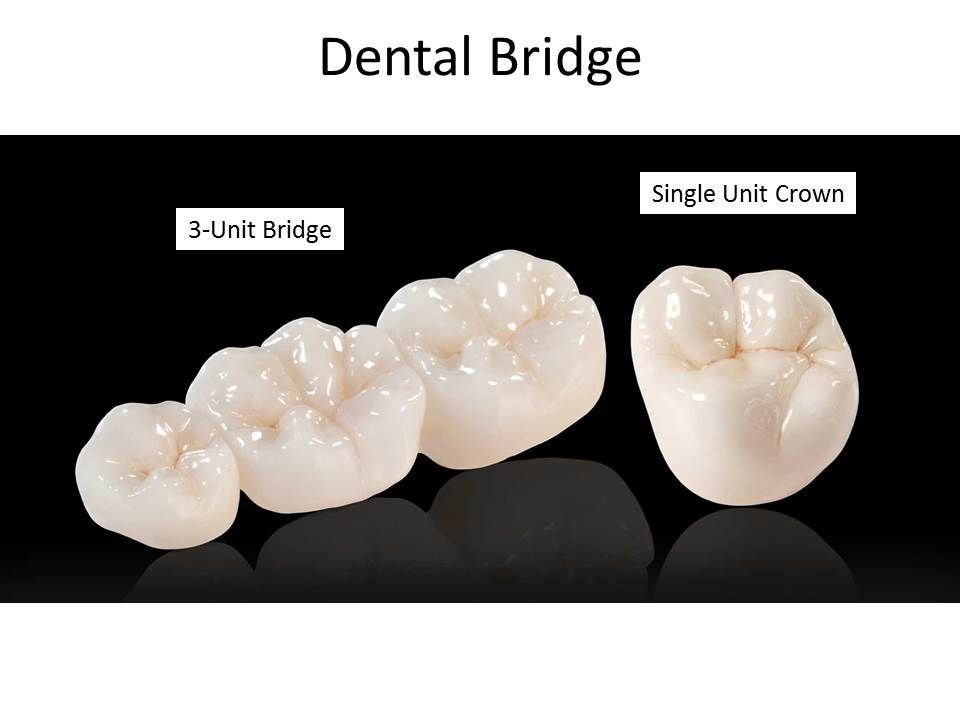 Single Unit Dental Crown Marina Del Rey