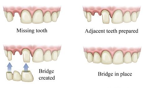 Dental Bridge Marina Del Rey