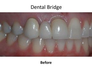 Dental Bridge Before