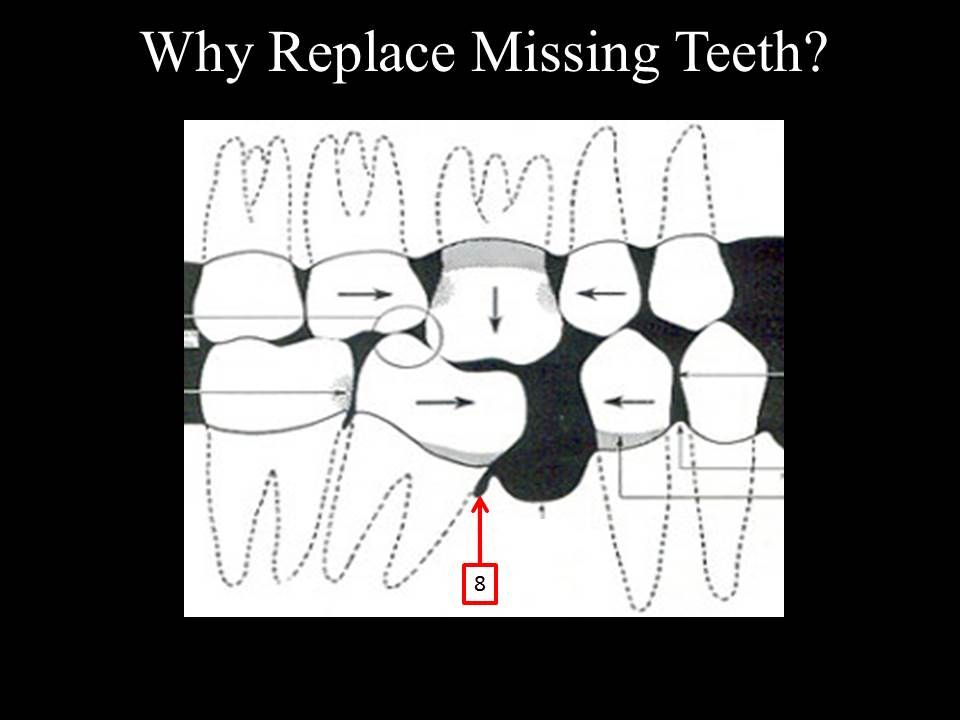 replace missing teeth with dental implants