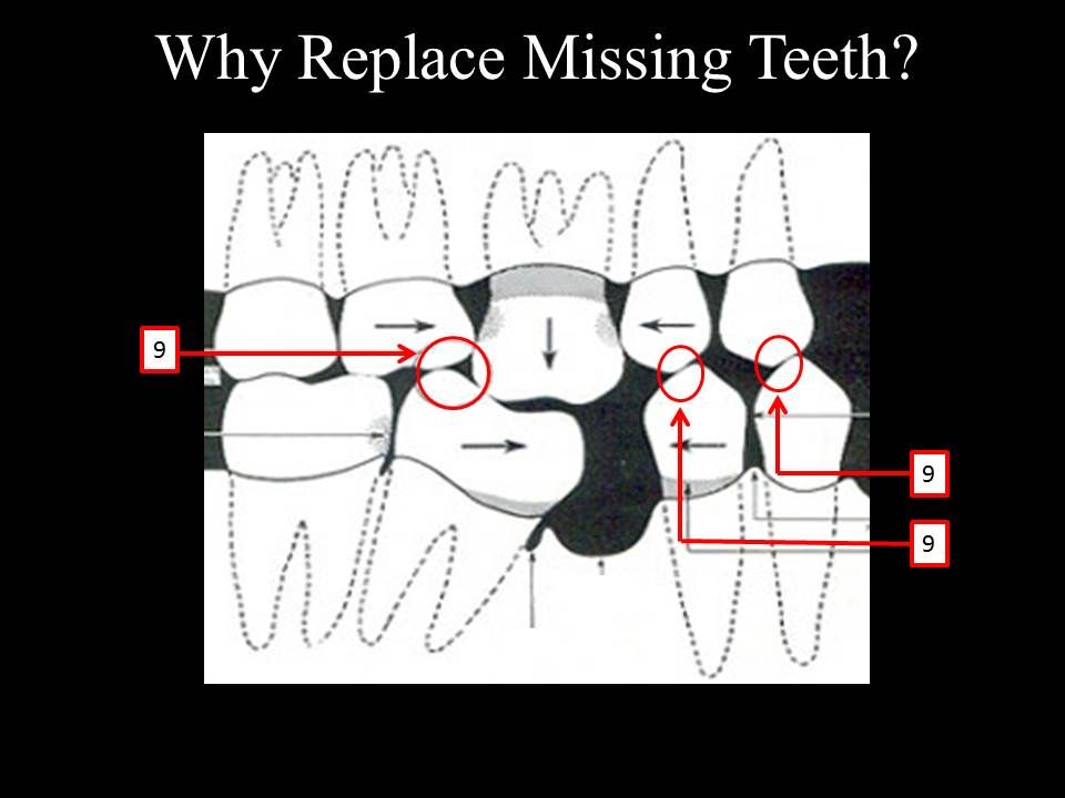 why replace missing teeth with implants