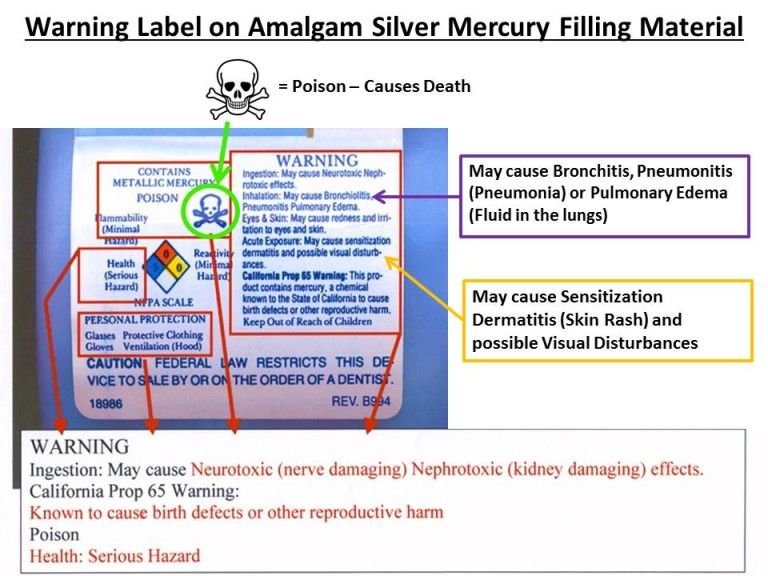 Warning label on Amalgam Silver Mercury filling material