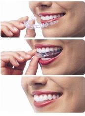 Clear Aligner Therapy