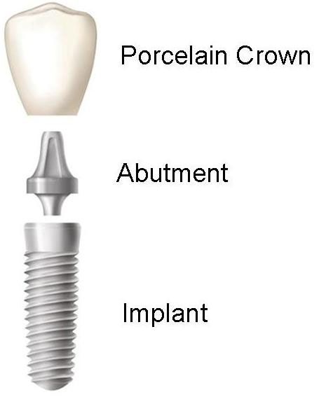 Implant Restoration