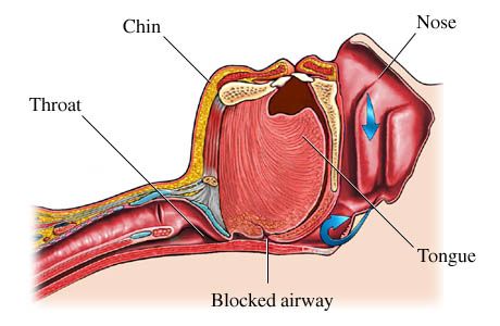 Marina Del Rey dentist finds sleep apnea solutions