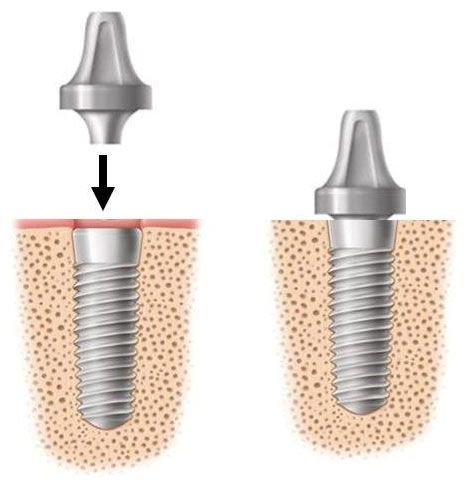 Tooth Replacement Step 2