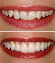 Straightening crooked teeth