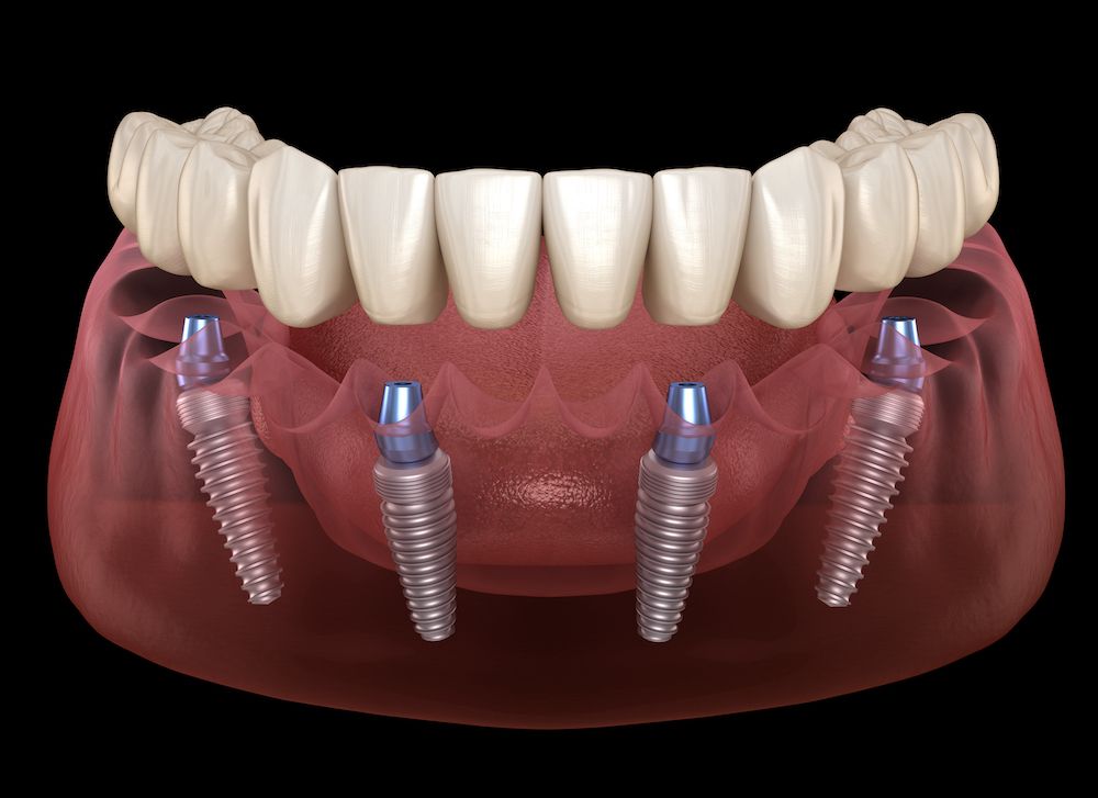 The All-on-4® Implant Procedure: What to Expect