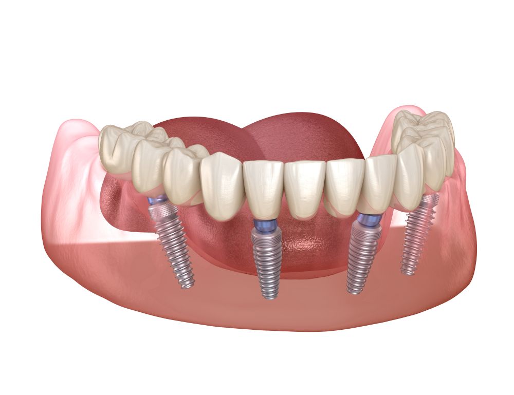 Who Is a Candidate for All-on-4 Dental Implants? Eligibility Criteria and Considerations