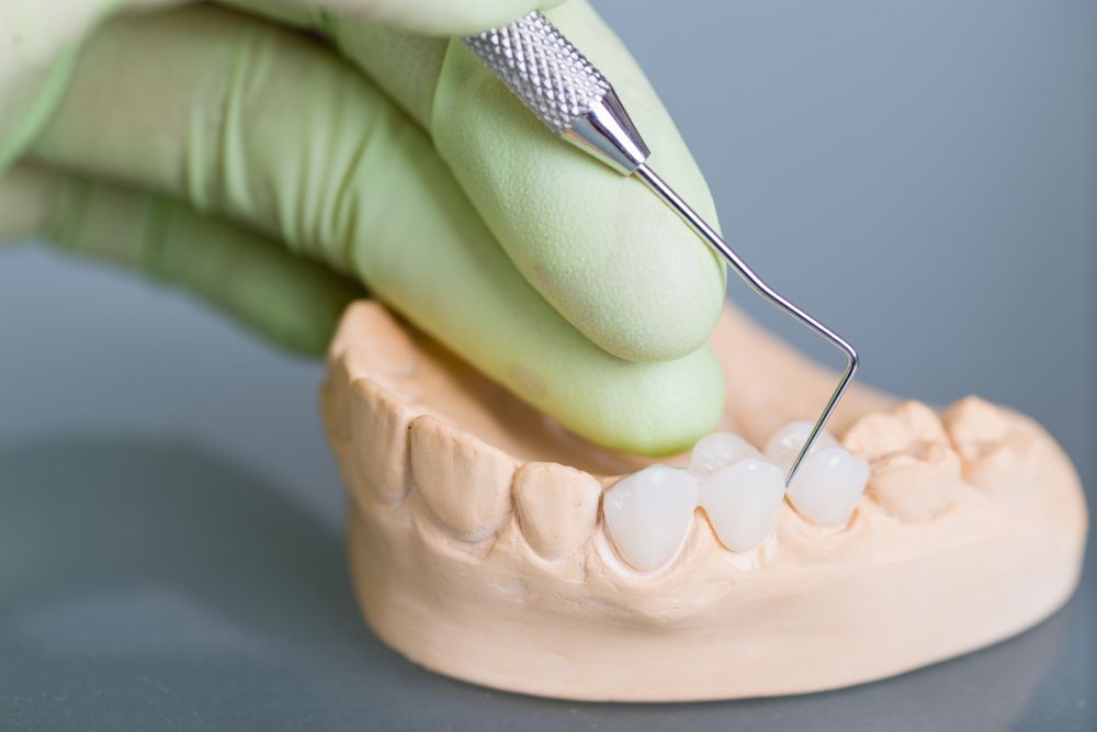 Are Dental Bridges Right for You? Assessing Your Candidacy