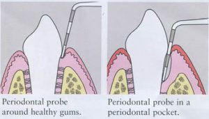 periodontal probe