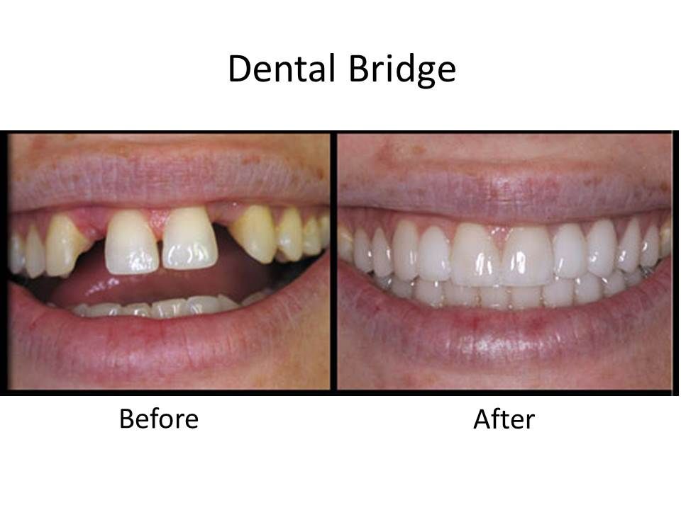 before and after dental bridges