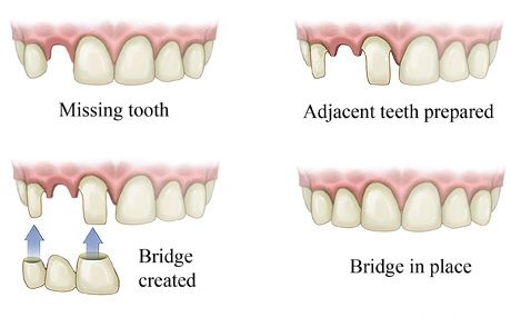 diagram of dental bridges
