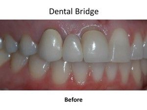 before dental bridges