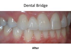 after dental bridges