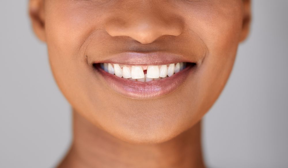 How Long Does it Take to Close the Gaps Between Your Teeth?