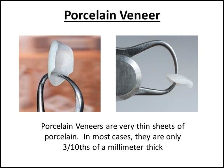 porcelain veneer