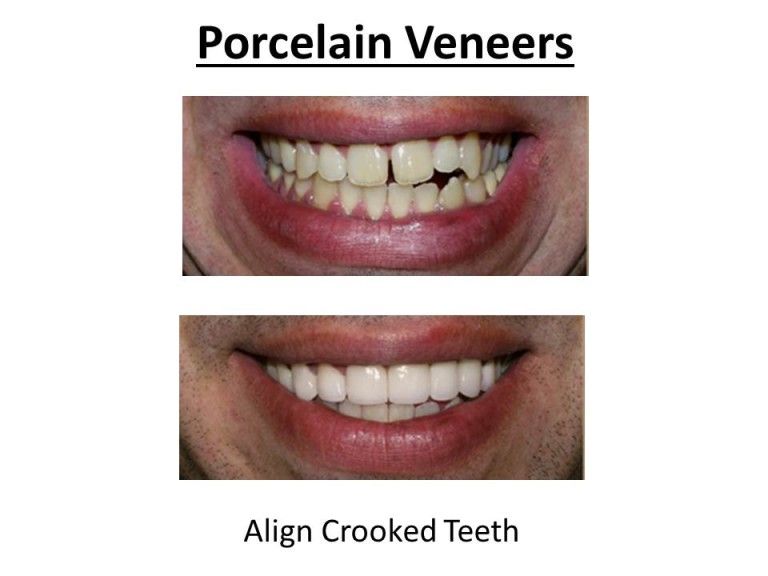 benefits of porcelain veneers